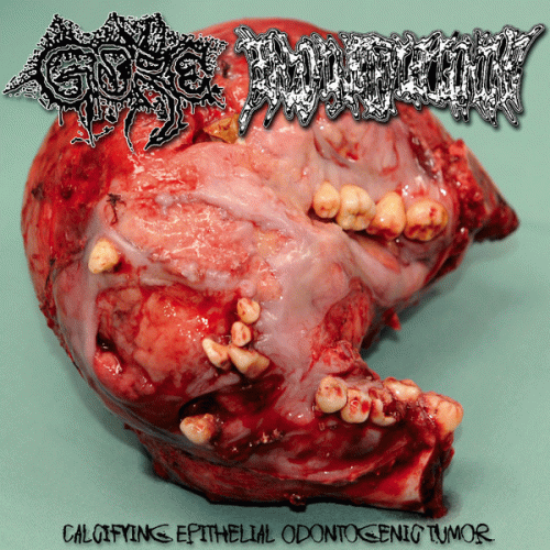 Benzoylmethylecgonine : Calcifying Epithelial Odontogenic Tumor